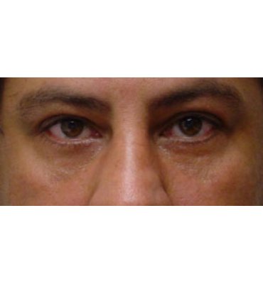Facelift & Facial Skin Rejuvenation After